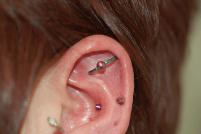 Ashley also had her orbital done in the same sitting - what a champ
