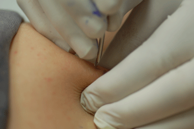 In goes one of the needles..