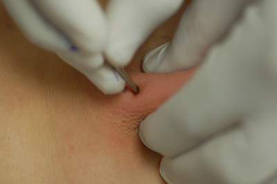 Now the other needle