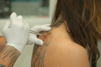 installing the dermals