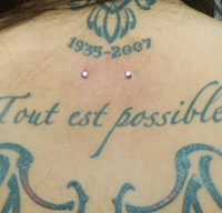 Double Dermals