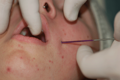 Put the taper right through the needle