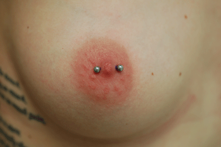 implant grade surgical steel
