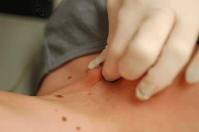 There's where the dermal will sit in..