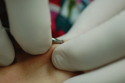 beginning the procedure