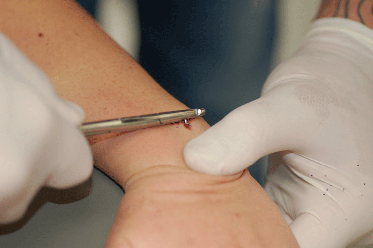 it takes a well skilled piercer to get the dermal in quickly and deeply