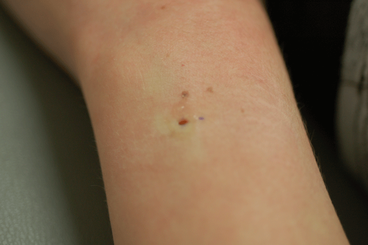 it's actually a pretty small incision