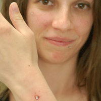 Wrist Dermal
