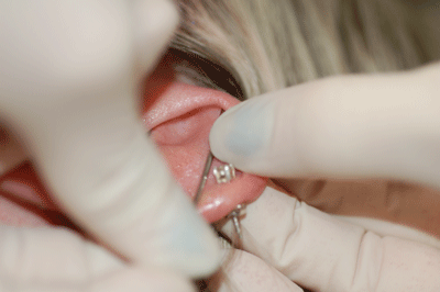 There goes one needle!