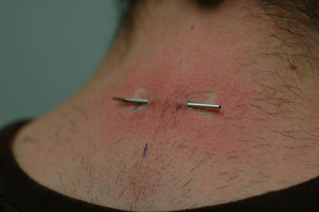 Perfectly straight needle!