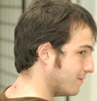 Awesome surface piercing!