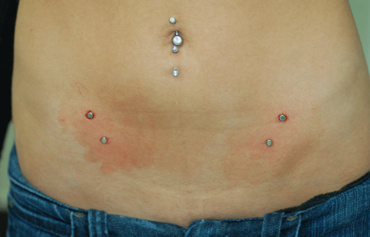 I'm getting Hip Dermals now. 