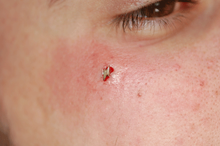 Trae is sure to get a ton of compliments on his dermal!